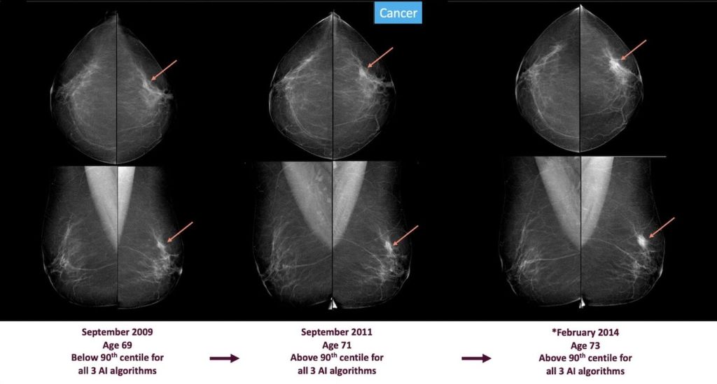signs of breast cancer could be spotted 3 6 years before diagnosis using ai screening, shows massive study