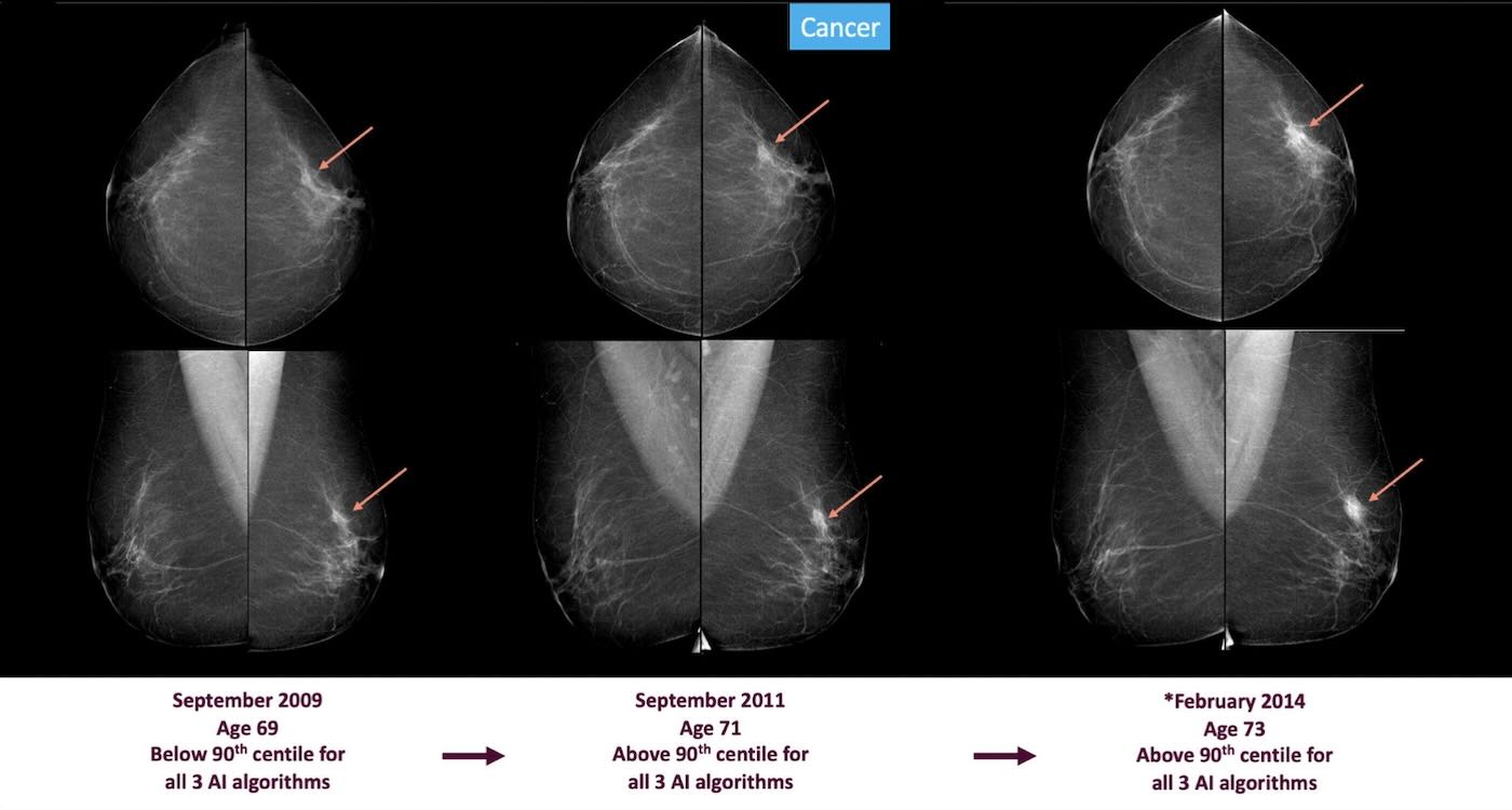 signs of breast cancer could be spotted 3 6 years before diagnosis using ai screening, shows massive study