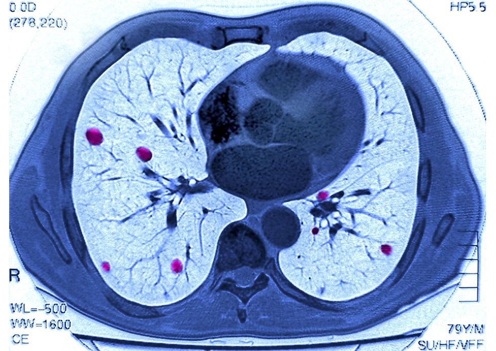 Lung cancer breakthrough could cut treatment delays for thousands lung cancer breakthrough could cut treatment delays for thousands
