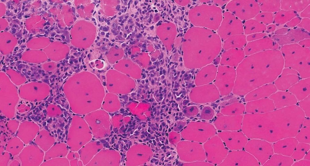 new treatment shows remarkable motor improvements in boys with muscular dystrophy—in just 12 weeks